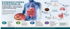 Strongyloides stercoralis: Symptoms, Life Cycle, Diagnosis, Treatment and Prevention