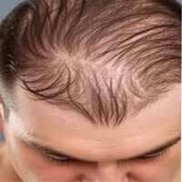 Hair Loss
