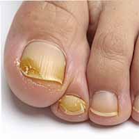 Nail Fungus